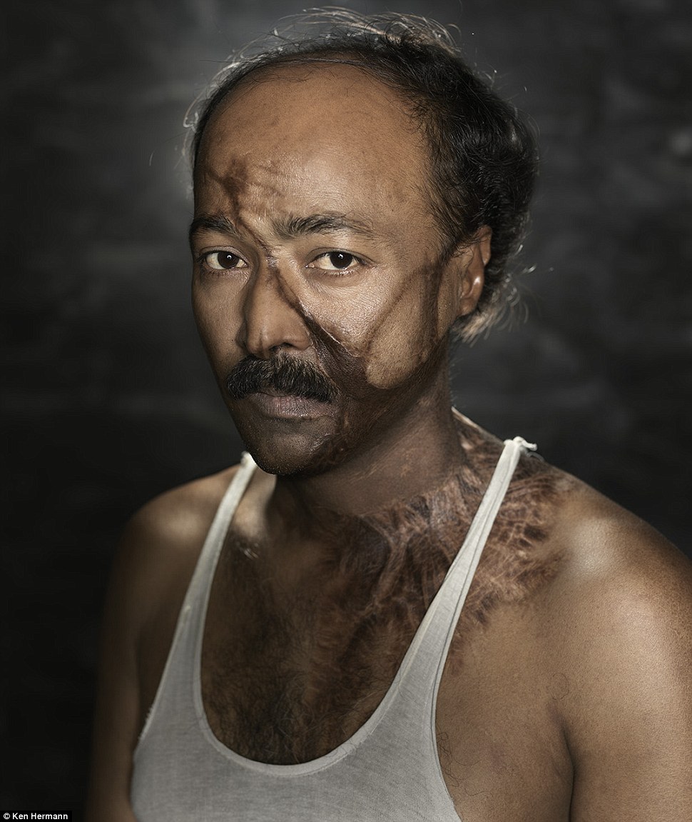 Жители Бангладеш, облитые кислотой, рассказывают о причинах своих ужасных увечий Бангладеш кислота, Кен Германн Ken Hermann, люди облитые кислотой