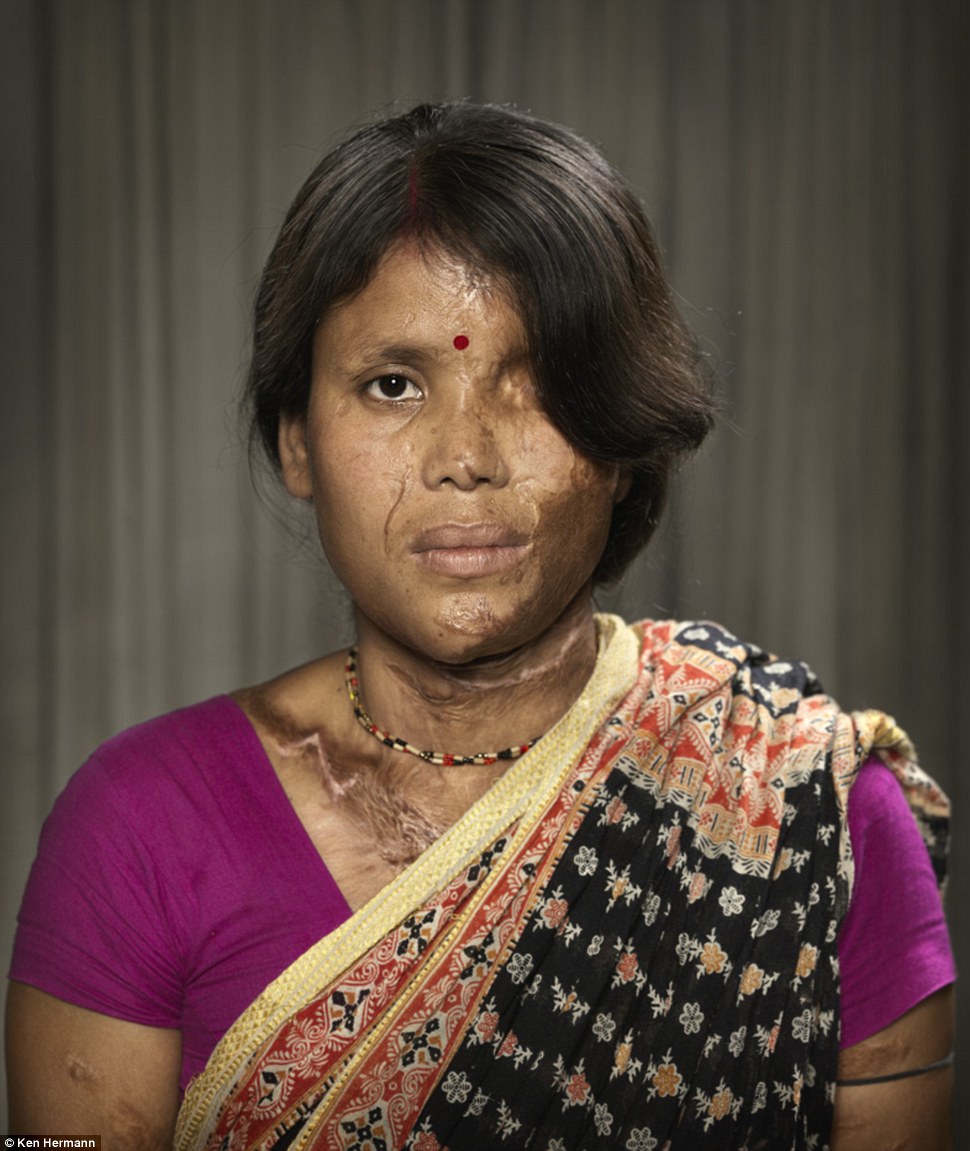 Жители Бангладеш, облитые кислотой, рассказывают о причинах своих ужасных увечий Бангладеш кислота, Кен Германн Ken Hermann, люди облитые кислотой