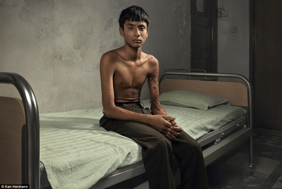 Жители Бангладеш, облитые кислотой, рассказывают о причинах своих ужасных увечий Бангладеш кислота, Кен Германн Ken Hermann, люди облитые кислотой