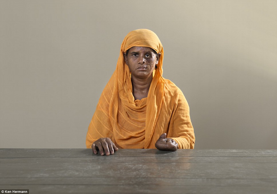 Жители Бангладеш, облитые кислотой, рассказывают о причинах своих ужасных увечий Бангладеш кислота, Кен Германн Ken Hermann, люди облитые кислотой