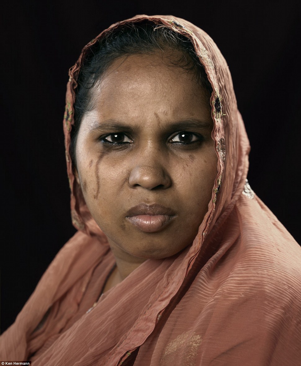 Жители Бангладеш, облитые кислотой, рассказывают о причинах своих ужасных увечий Бангладеш кислота, Кен Германн Ken Hermann, люди облитые кислотой