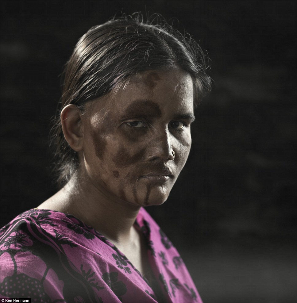 Жители Бангладеш, облитые кислотой, рассказывают о причинах своих ужасных увечий Бангладеш кислота, Кен Германн Ken Hermann, люди облитые кислотой