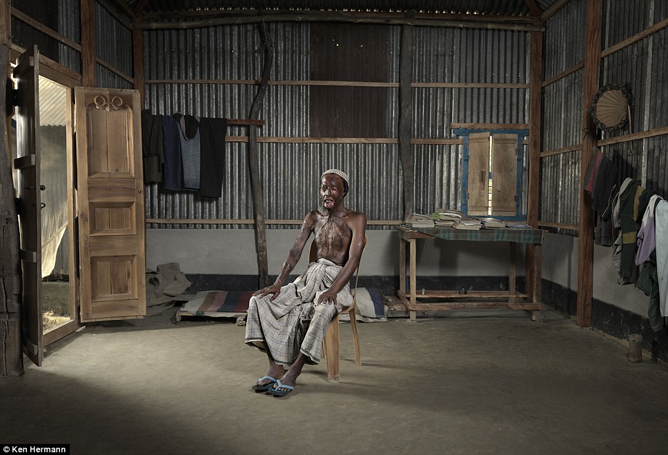 Жители Бангладеш, облитые кислотой, рассказывают о причинах своих ужасных увечий Бангладеш кислота, Кен Германн Ken Hermann, люди облитые кислотой