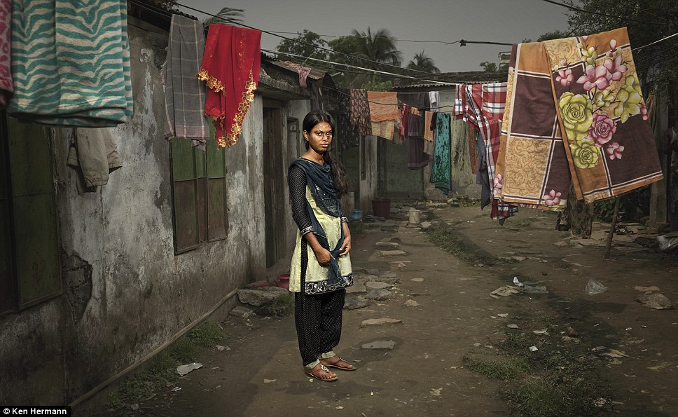 Жители Бангладеш, облитые кислотой, рассказывают о причинах своих ужасных увечий Бангладеш кислота, Кен Германн Ken Hermann, люди облитые кислотой