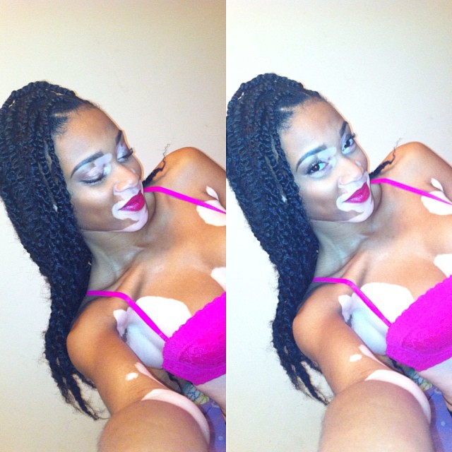 Chantelle Winnie, Шантель Винни, модель с нарушением пигментации кожи, Chantelle Winnie