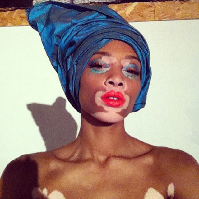 Chantelle Winnie, Шантель Винни, модель с нарушением пигментации кожи, Chantelle Winnie
