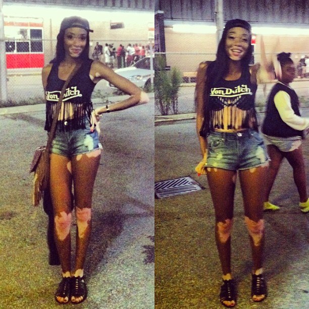 Chantelle Winnie, Шантель Винни, модель с нарушением пигментации кожи, Chantelle Winnie