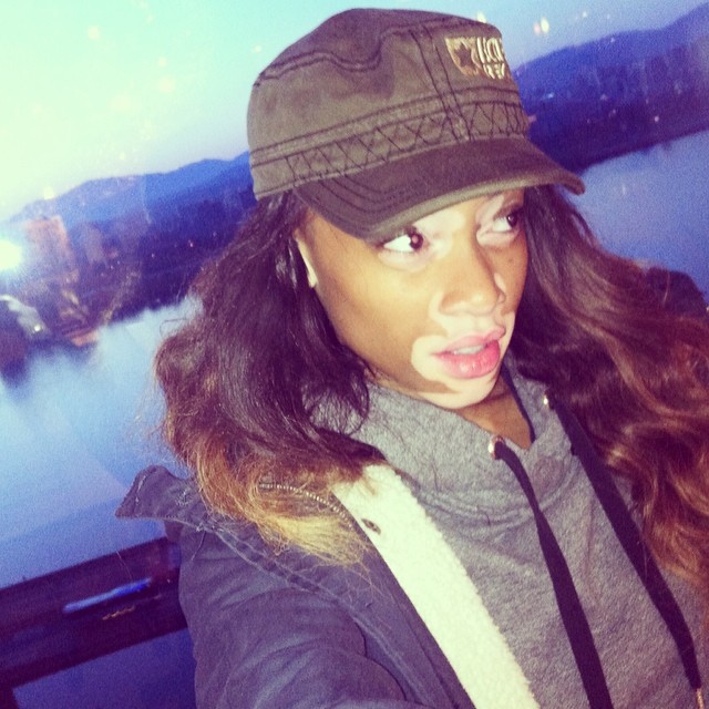 Chantelle Winnie, Шантель Винни, модель с нарушением пигментации кожи, Chantelle Winnie