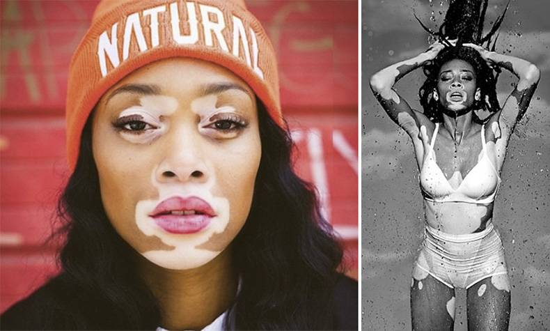 Chantelle Winnie, Шантель Винни, модель с нарушением пигментации кожи, Chantelle Winnie