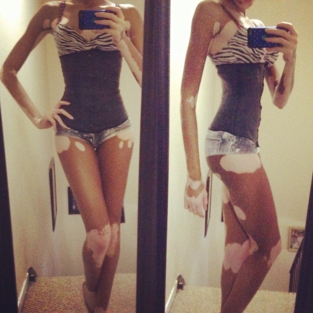 Chantelle Winnie, Шантель Винни, модель с нарушением пигментации кожи, Chantelle Winnie