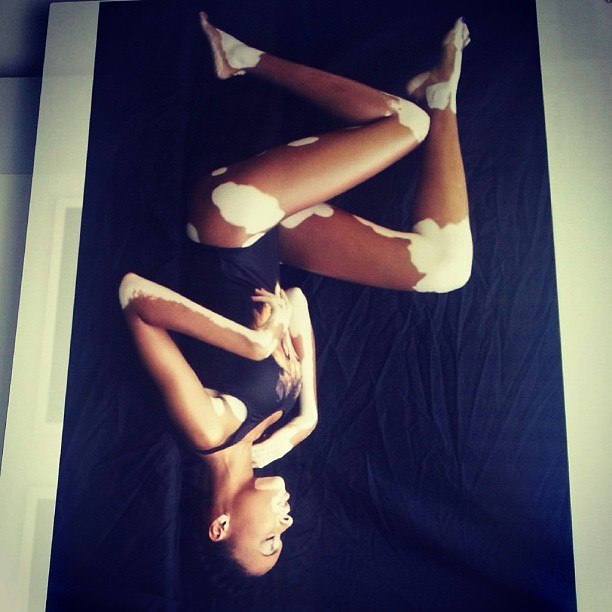 Chantelle Winnie, Шантель Винни, модель с нарушением пигментации кожи, Chantelle Winnie