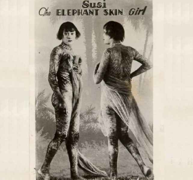 фрик-шоу, цирк уродов, физические дефекты, винтажные фотографии