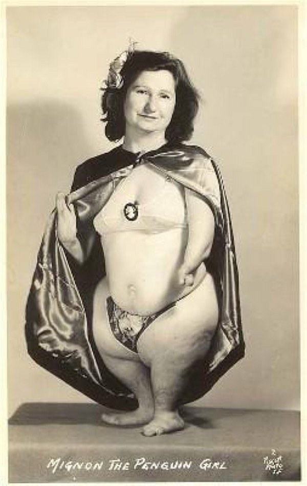 фрик-шоу, цирк уродов, физические дефекты, винтажные фотографии