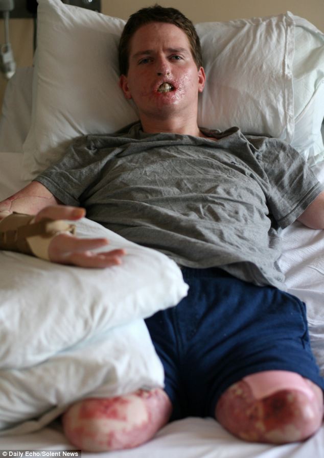 Алекс Льюис, Alex Lewis, ампутировали 3 конечности некротический фасциит