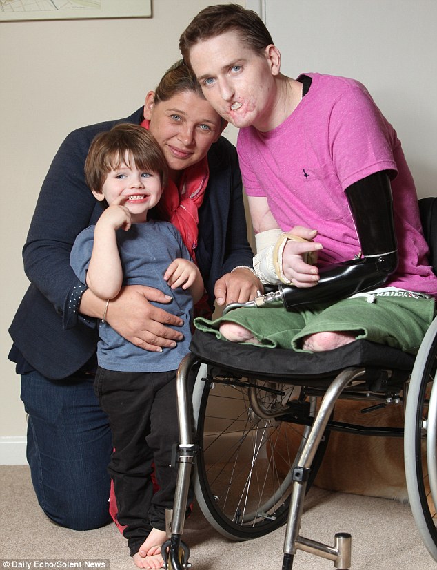 Алекс Льюис, Alex Lewis, ампутировали 3 конечности некротический фасциит