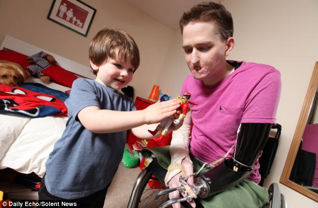 Алекс Льюис, Alex Lewis, ампутировали 3 конечности некротический фасциит