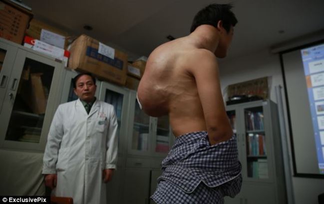 китаец, нарост на спине, опухоль, 10 кг на спине, Yang Xiao