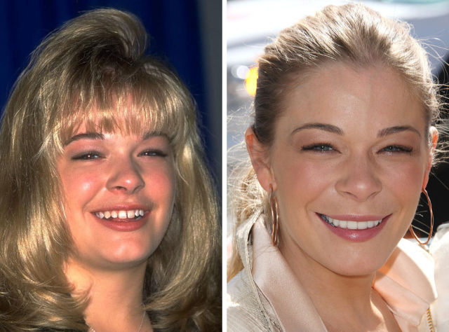 зубы звёзд, зубы знаменитостей до и после