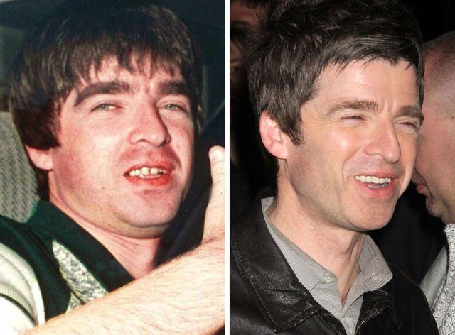 зубы звёзд, зубы знаменитостей до и после