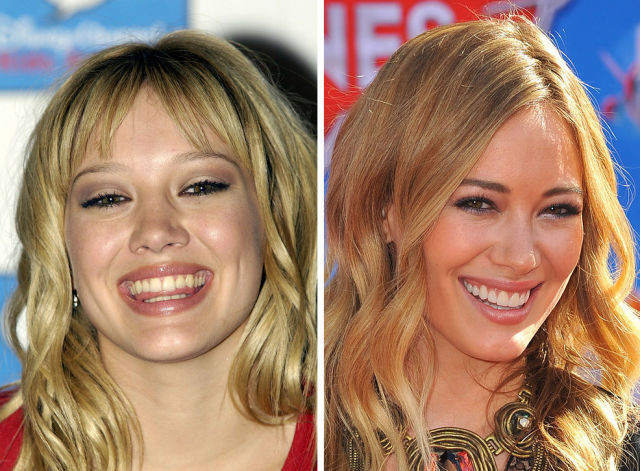Зубы пугачевой до и после фото