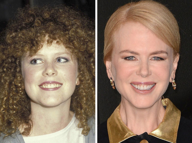 зубы звёзд, зубы знаменитостей до и после