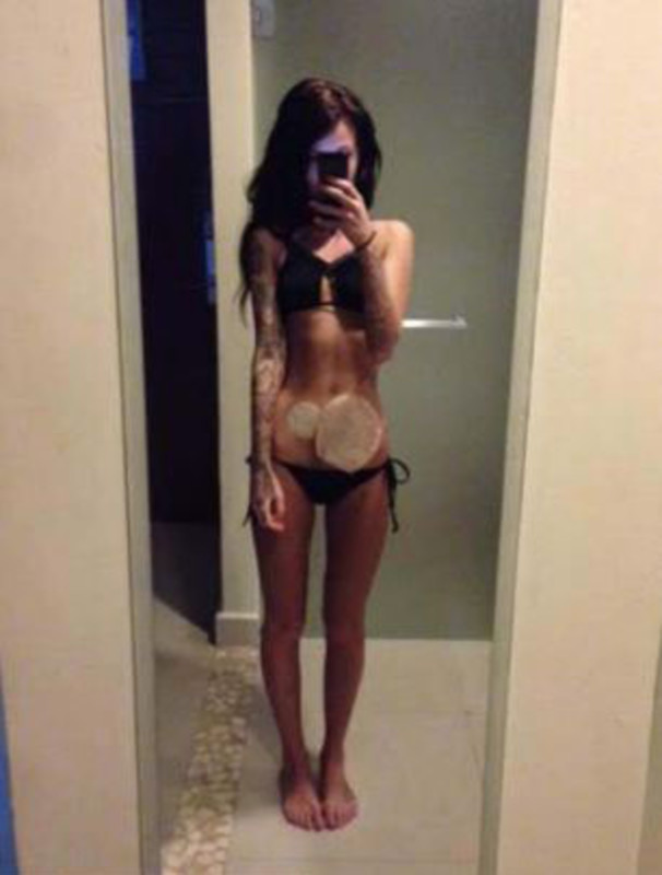 Bethany Townsend Бетани Таунсенд, болезнь Крона