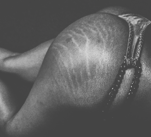 Instagram Love Your Lines, инстаграм растяжки, полюби свои растяжки