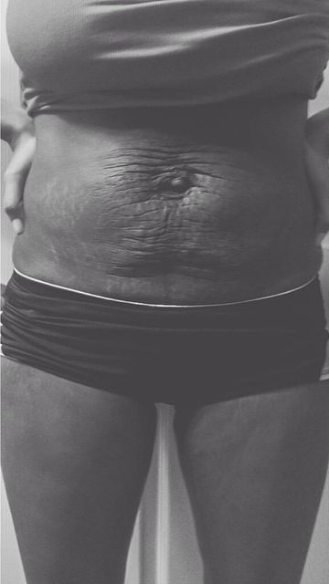 Instagram Love Your Lines, инстаграм растяжки, полюби свои растяжки