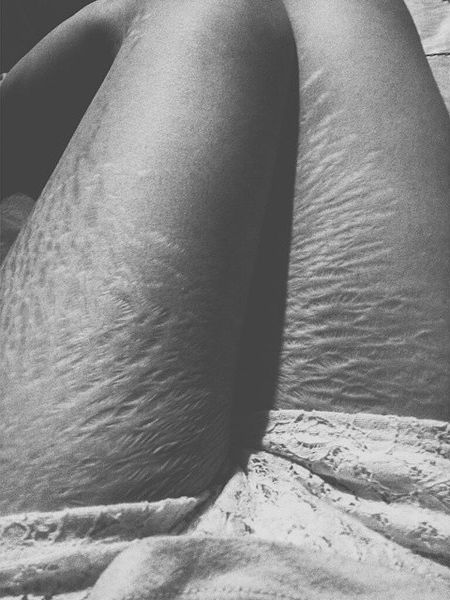 Instagram Love Your Lines, инстаграм растяжки, полюби свои растяжки