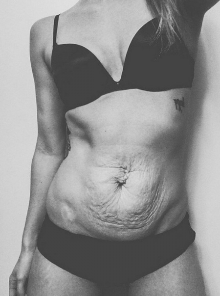 Instagram Love Your Lines, инстаграм растяжки, полюби свои растяжки