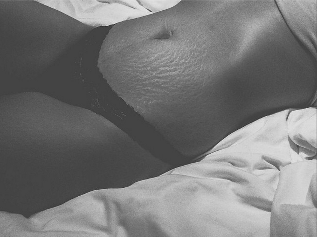 Instagram Love Your Lines, инстаграм растяжки, полюби свои растяжки