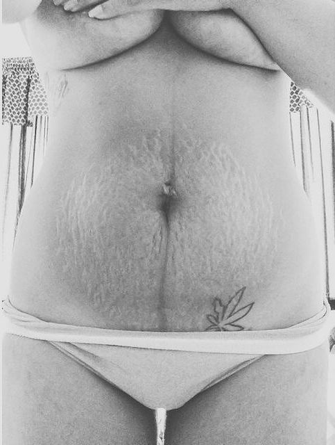 Instagram Love Your Lines, инстаграм растяжки, полюби свои растяжки