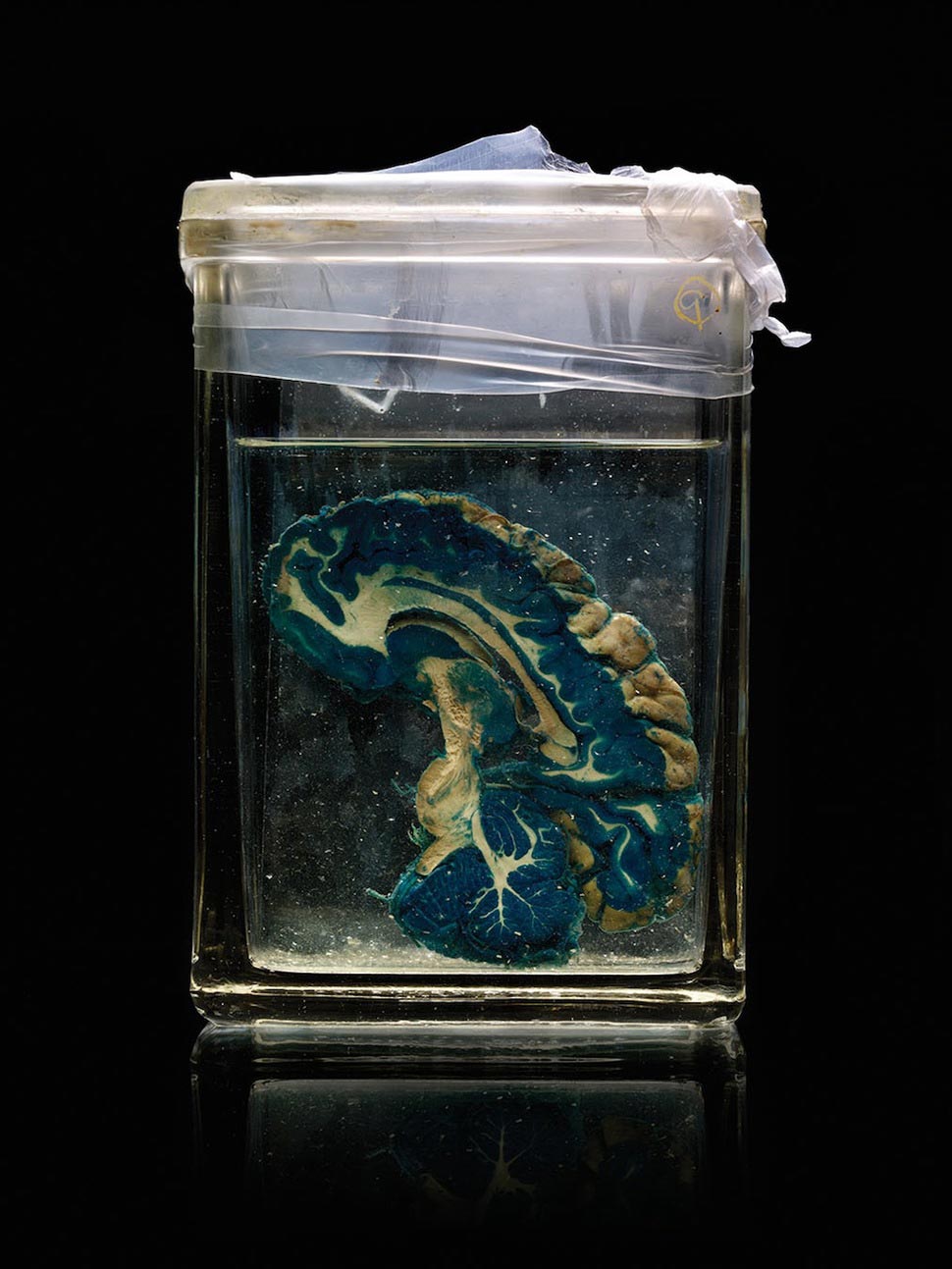 мозги психбольницы Техаса, мозги пациентов в банках, Адам Вурхес,Adam Voorhes