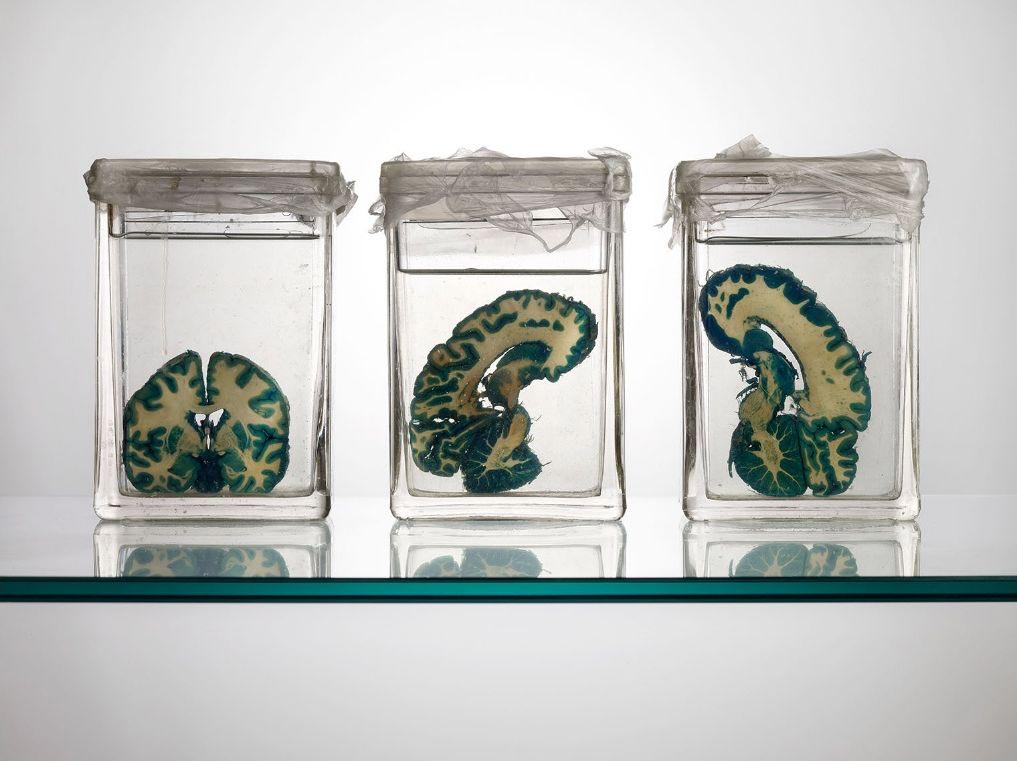 мозги психбольницы Техаса, мозги пациентов в банках, Адам Вурхес,Adam Voorhes