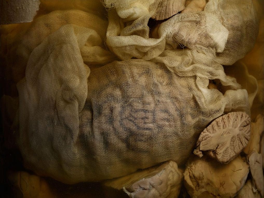 мозги психбольницы Техаса, мозги пациентов в банках, Адам Вурхес,Adam Voorhes