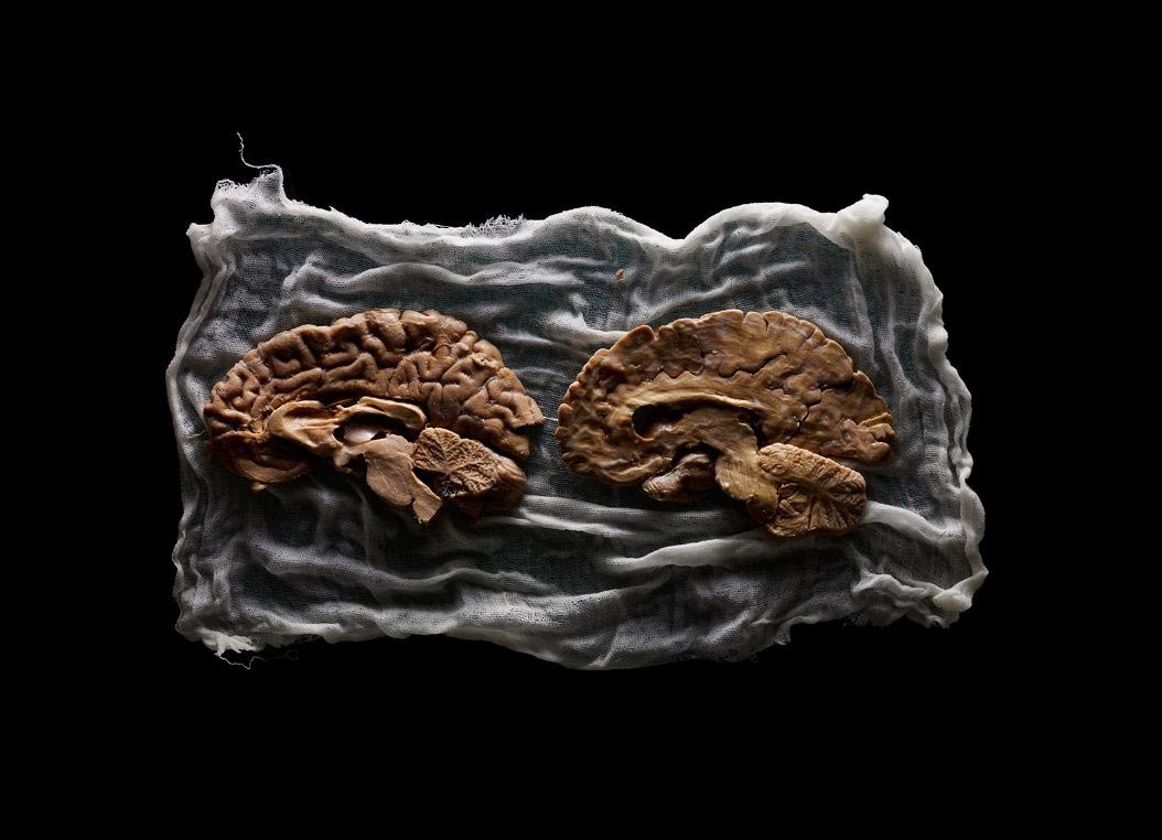 мозги психбольницы Техаса, мозги пациентов в банках, Адам Вурхес,Adam Voorhes