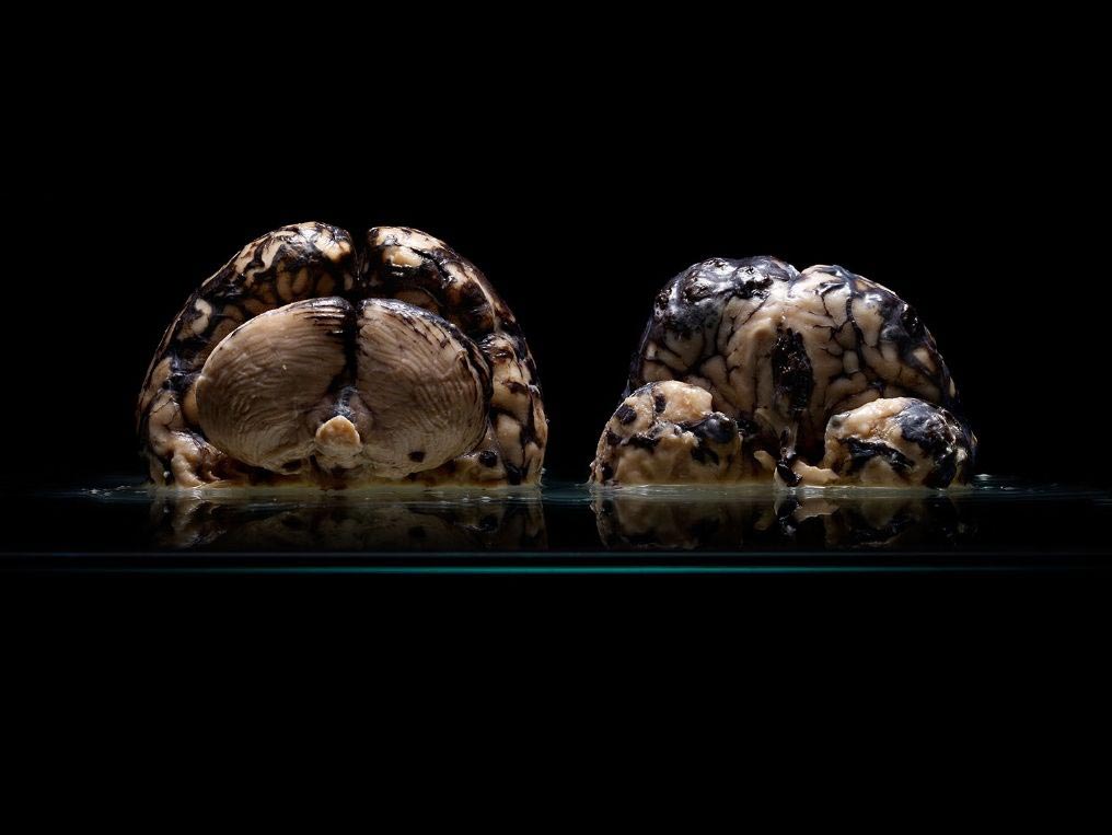 мозги психбольницы Техаса, мозги пациентов в банках, Адам Вурхес,Adam Voorhes