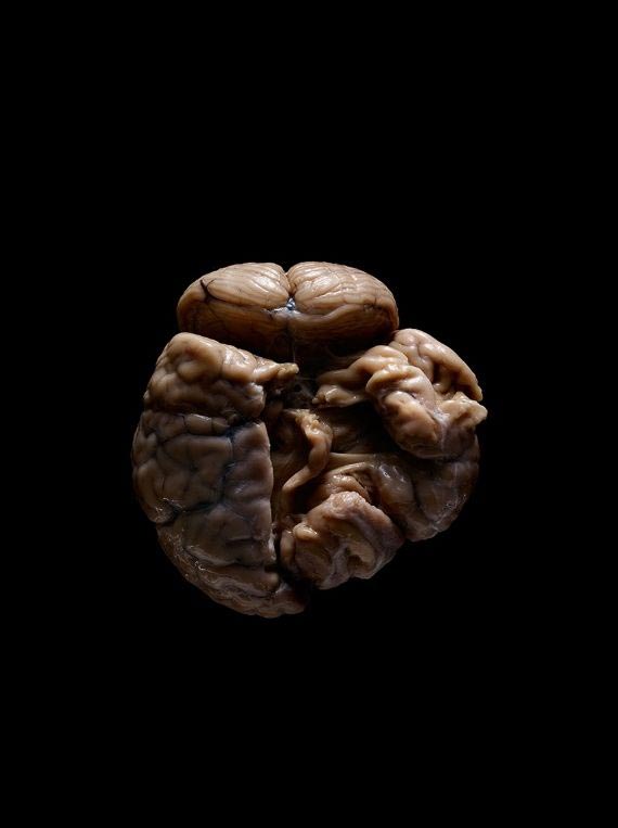 мозги психбольницы Техаса, мозги пациентов в банках, Адам Вурхес,Adam Voorhes