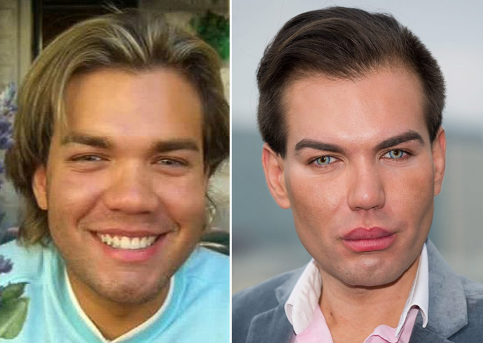 Родриго Алвес пластические операции, Rodrigo Alves