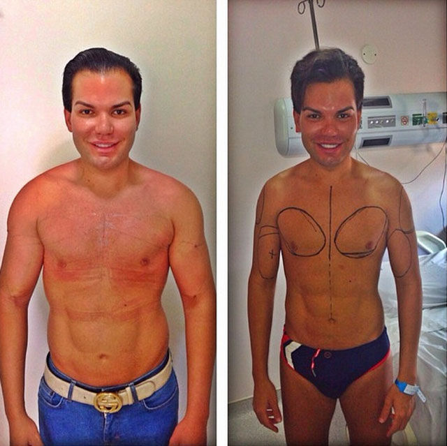 Родриго Алвес пластические операции, Rodrigo Alves