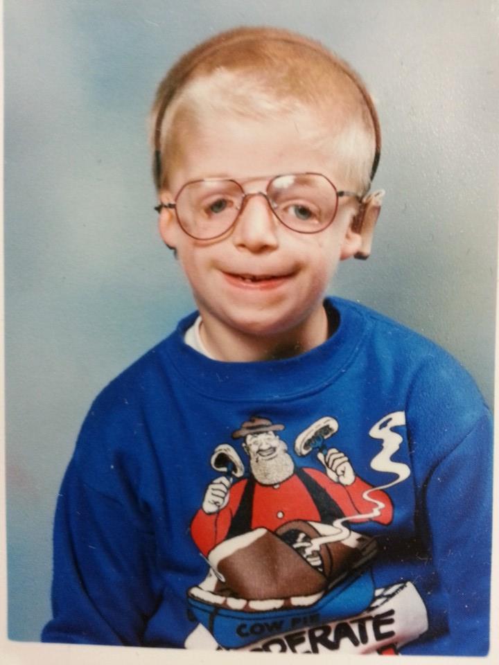 Джоно Ланкастер, Jono Lancaster, Синдром Тричера Коллинза, Treacher Collins syndrome