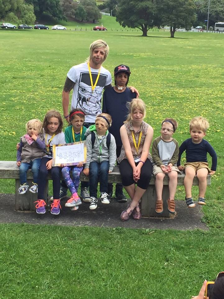 Джоно Ланкастер, Jono Lancaster, Синдром Тричера Коллинза, Treacher Collins syndrome