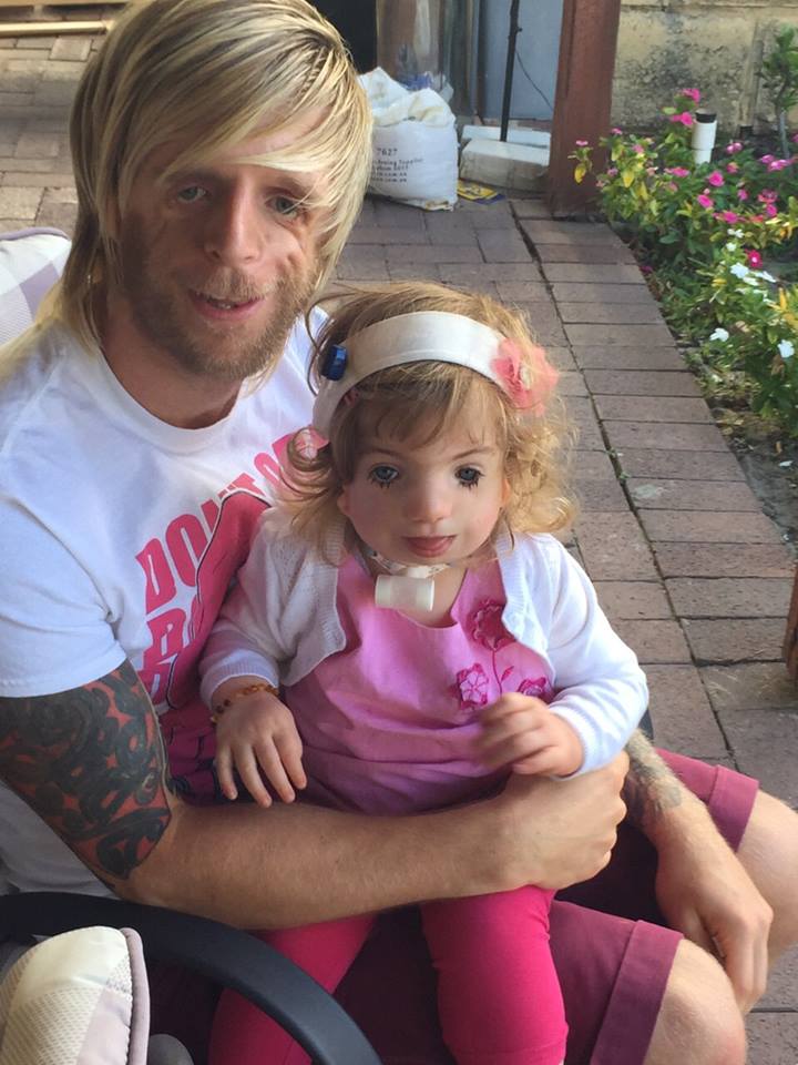 Джоно Ланкастер, Jono Lancaster, Синдром Тричера Коллинза, Treacher Collins syndrome