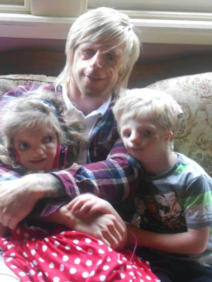 Джоно Ланкастер, Jono Lancaster, Синдром Тричера Коллинза, Treacher Collins syndrome