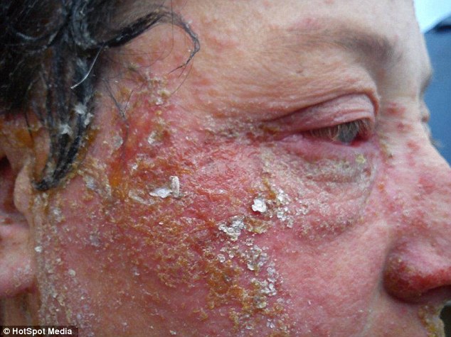 Страшная аллергическая реакция на краску для волос, изуродовавшая женщину до неузнаваемости аллергическая реакция на краску для волос. женщина аллергия на краску для волос, после аллергии на краску для волос