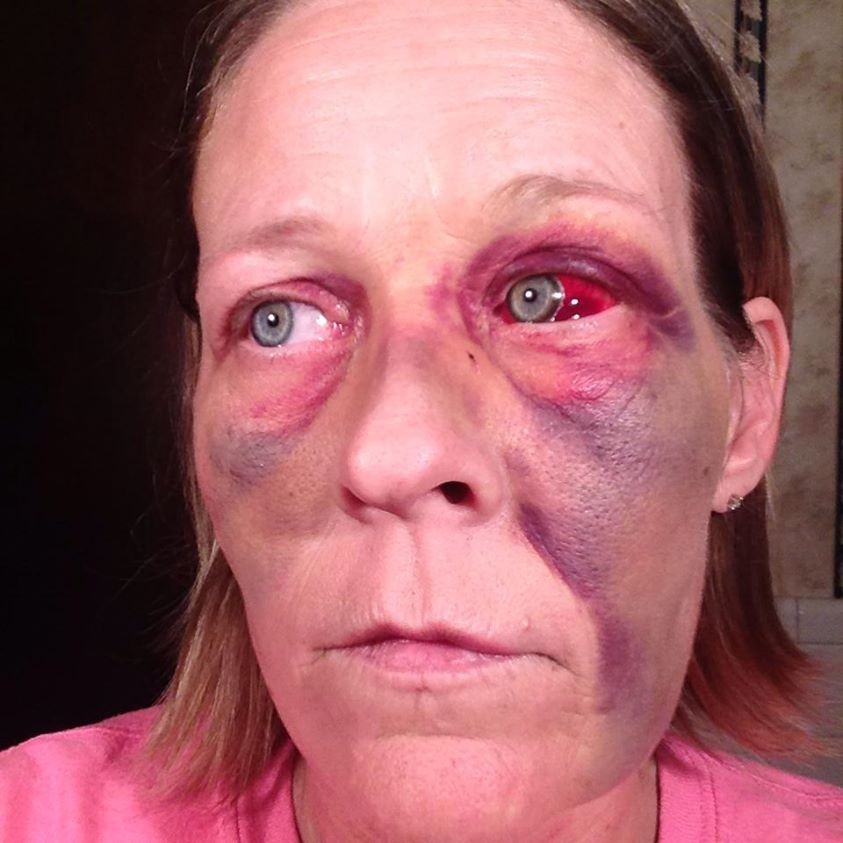 фотографии лица избил, женщину избил бывший, фото против насилия в семье, травмы лица женщина