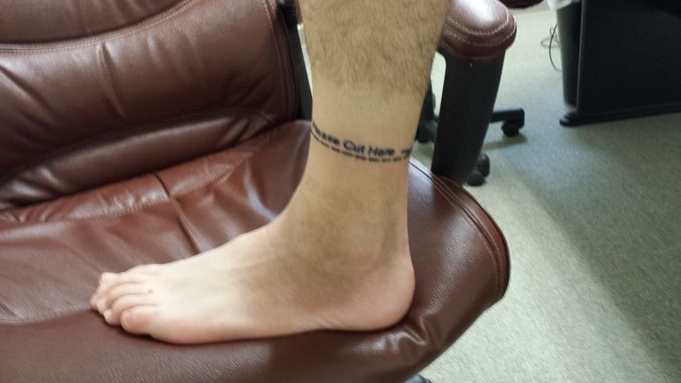 Никогда ещё ампутация ноги не была такой веселой веселая ампутация ноги, пигментный виллонодулярный синовит, ампутация ноги позитив