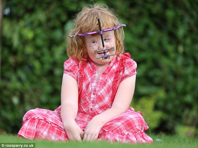 синдром Аперта, сломали череп и перестраивали заново, Кира Йейтс, Kira Yates, Девочка синдром Аперта