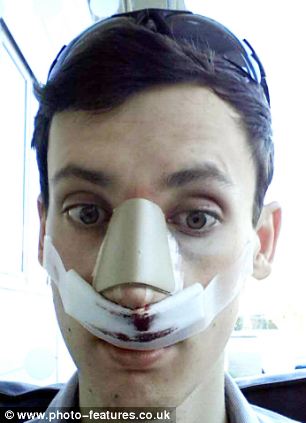 Пластическая хирургия фото нос