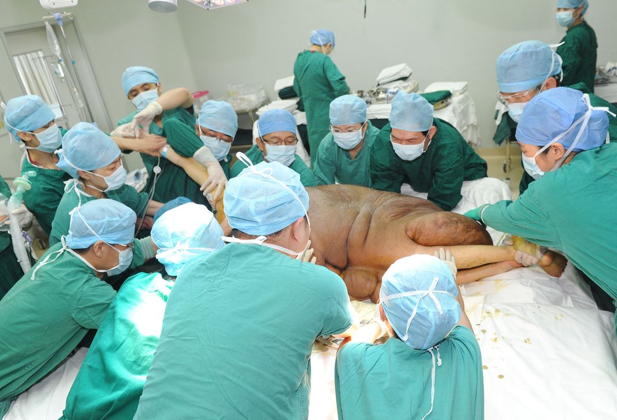 Мужчину с самой большой опухолью в мире избавили от новообразования весом в 108 кг Ян Джанбин Yang Jianbin, самая большая опухоль, опухоль 108 кг